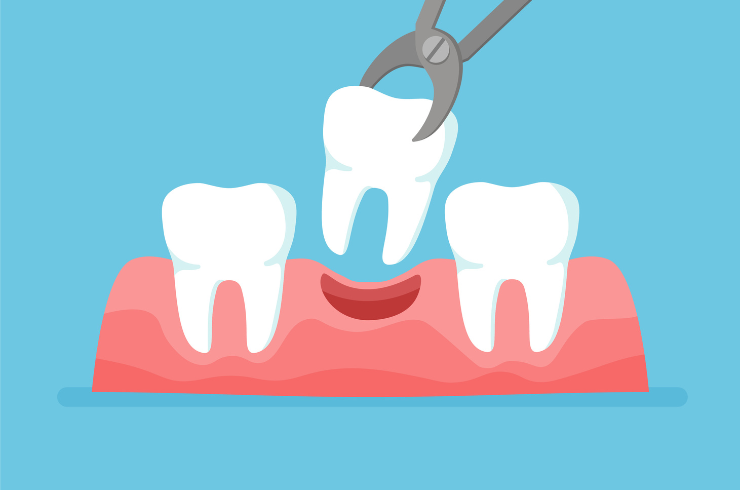 Tooth Extractions